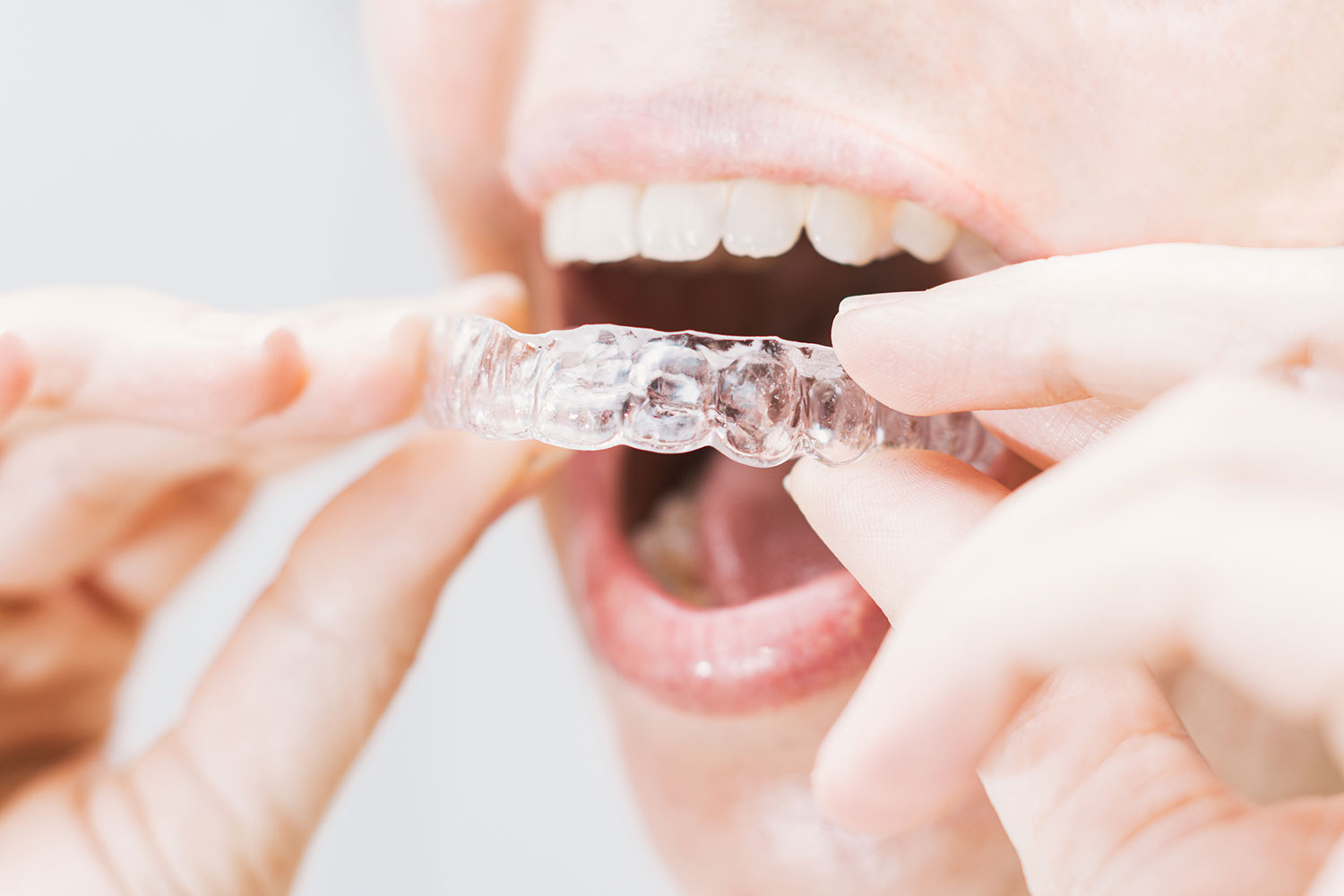 Overjet and Overbite: A Clear Aligner Guide - ClearPath Orthodontics
