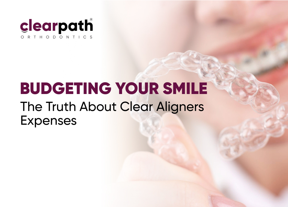 Budgeting Your Smile - Clear Aligner