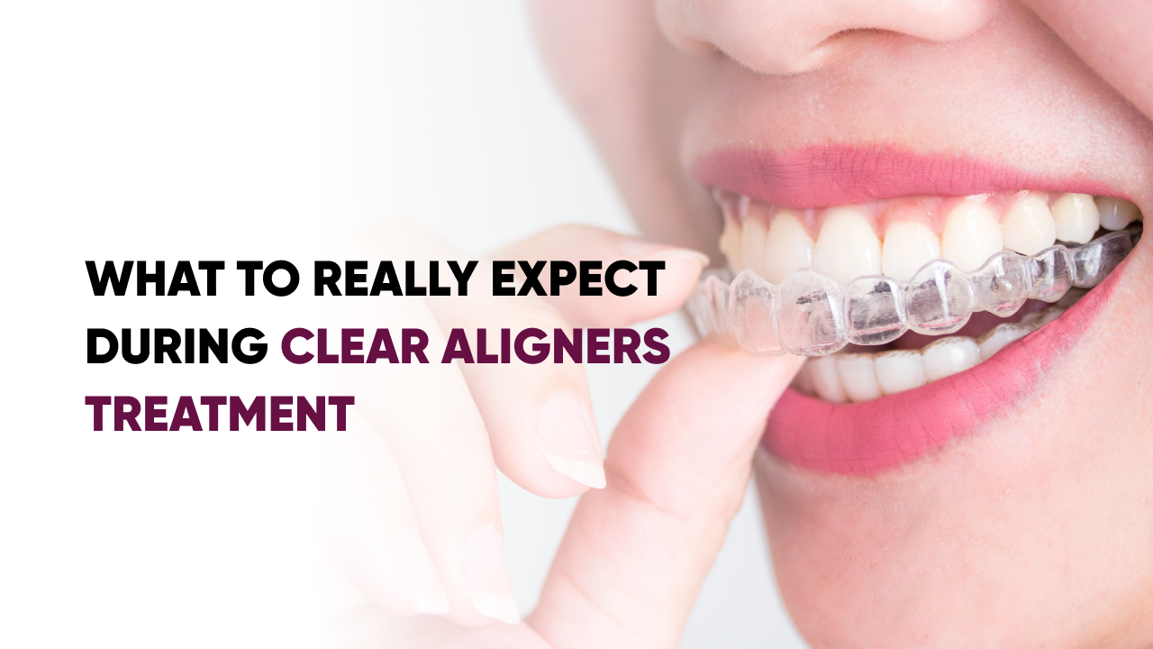 Clear Aligners Treatment