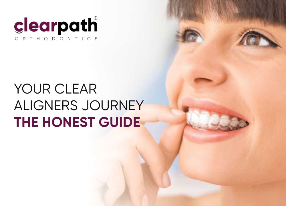 Clear Aligners Treatment Journey