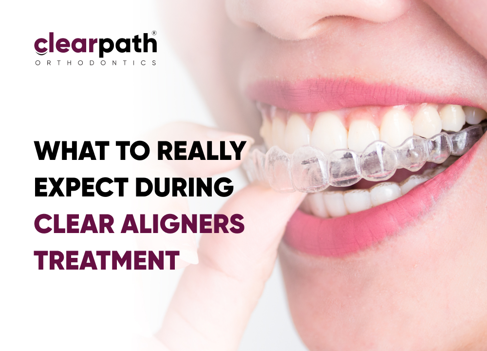 Clear Aligners Treatment