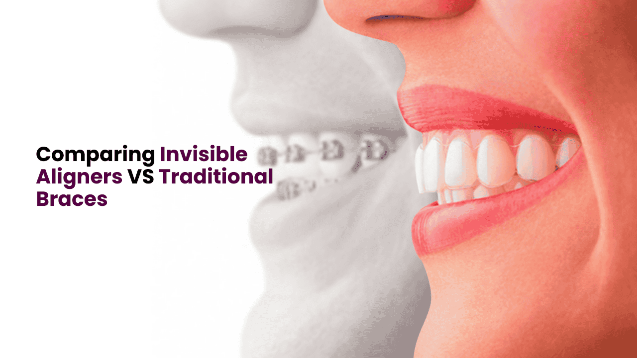 Invisible Aligners VS Traditional Braces