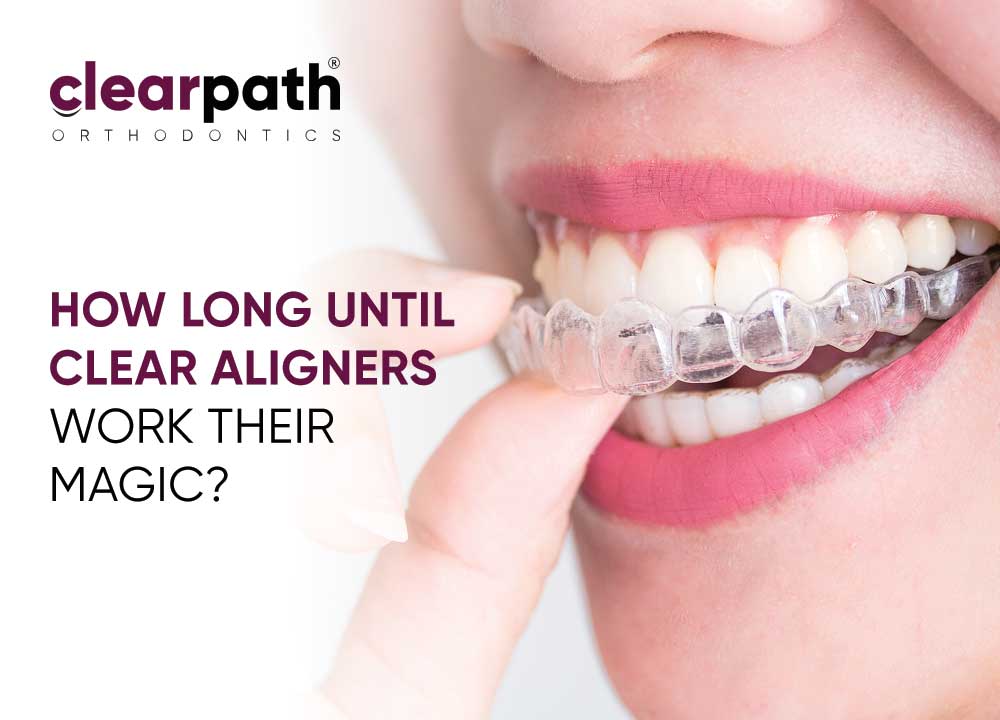 Do Aligners Take to Work