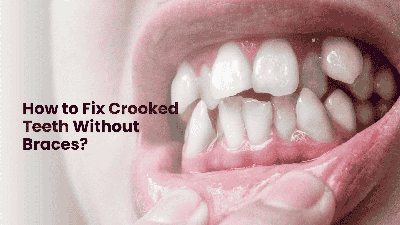 Crooked Teeth