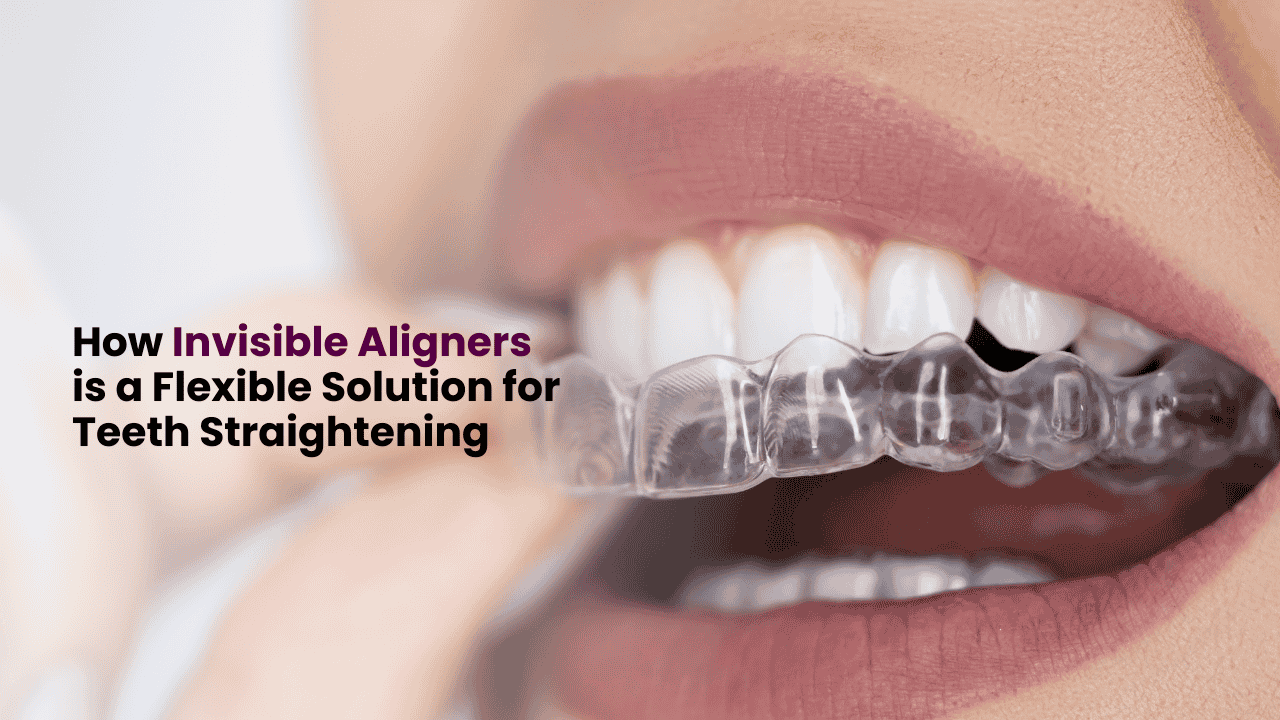 Invisible Aligners