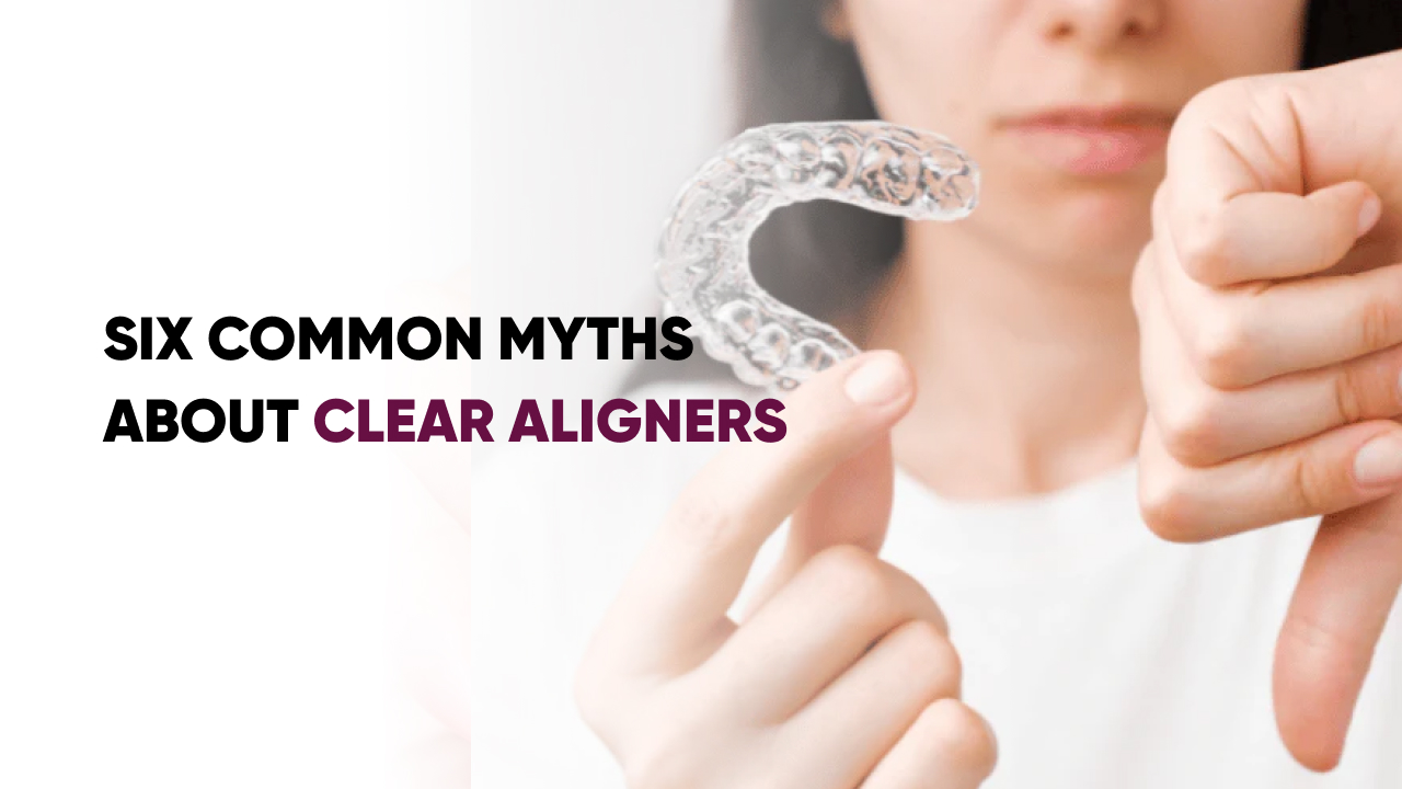 Myths About Clear Aligners