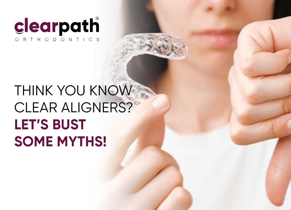 Myths About Clear Aligners