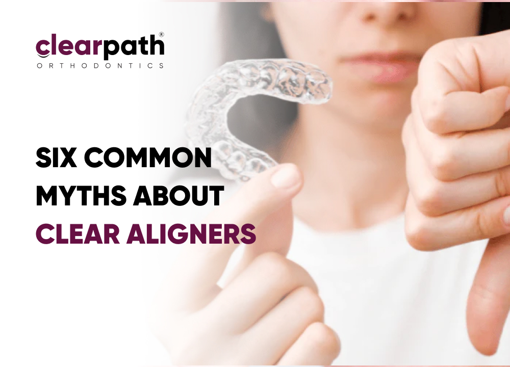 Myths About Clear Aligners