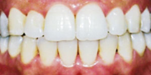 After Aligners 1