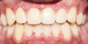 After Aligners 2