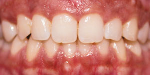 After Aligners 3