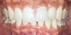 After Aligners 4