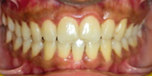 After Aligners 5