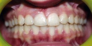 After Aligners 6