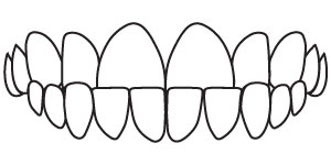 Cross Bite