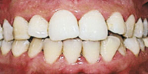 before aligners 1