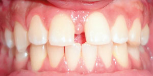 before aligners 2