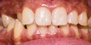 before aligners 3