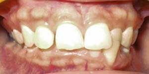 before aligners 4