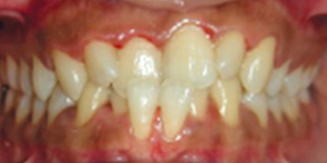 before aligners 5