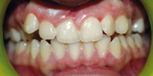 before aligners 6